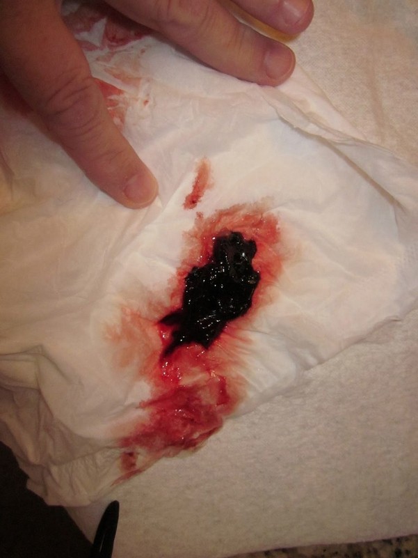Густая кровь во время менструации thumbnail