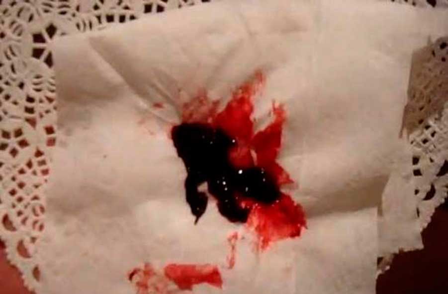 Большие сгустки крови во время менструации thumbnail
